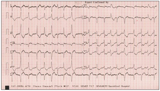 ECG after 2 hours showing gross ST-T changes. ST: segment, T: wave changes.