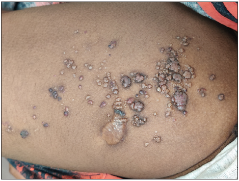 Multiple, discrete and grouped vesicles showing ‘Frog spawn’ appearance with few vesicles showing reddish and bluish hue present over the anterior aspect of the right thigh.