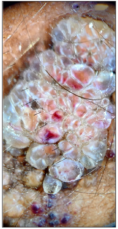 Dermoscopy (Heinz 20T, non-polarised mode, 10× magnification) shows multiple pale and orange coloured lacunae with few lacunae showing reddish discolouration at the bottom (Hypopyon sign).